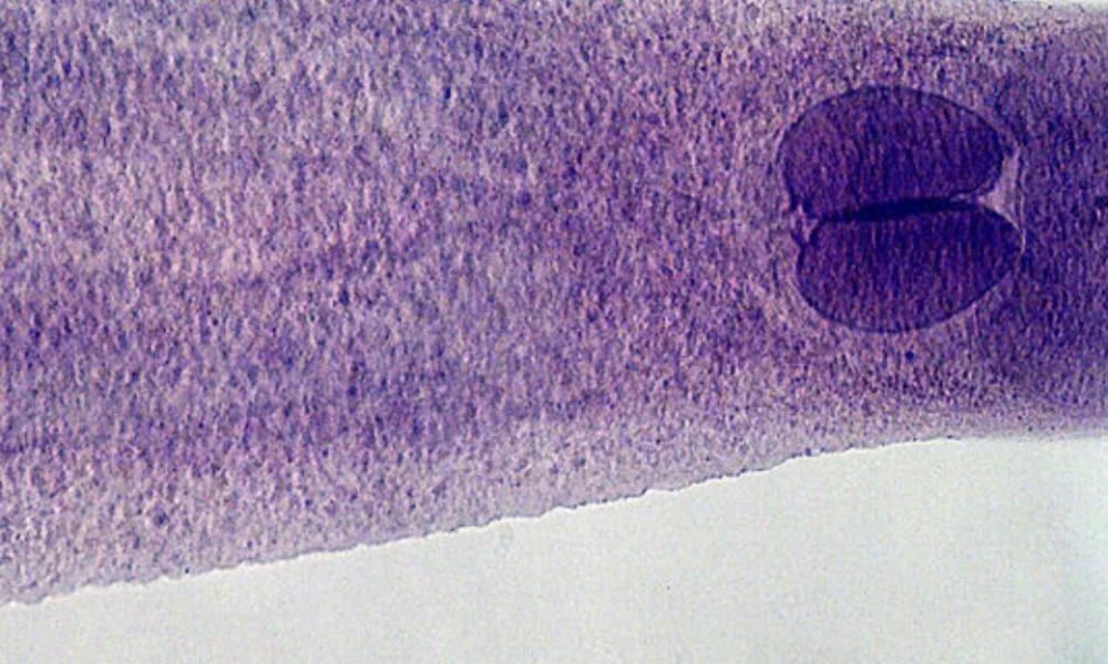 Έχασε το μισό συκώτι επειδή έφαγε ωμά ψάρια με παράσιτα